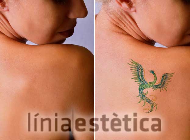 Eliminación de tatuajes Lleida con laser de pulso corto - Línia Estética